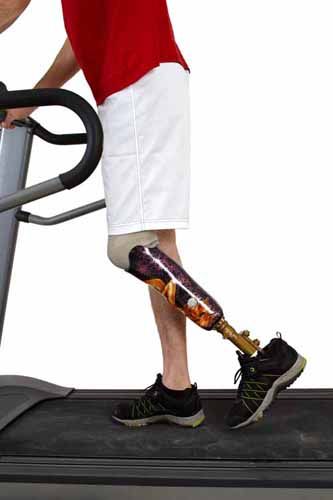 A person with a prosthetic leg walks on a treadmill